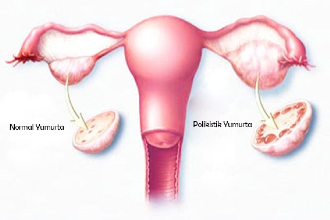 Polikistik Over Nedir?