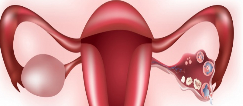 Endometriozis